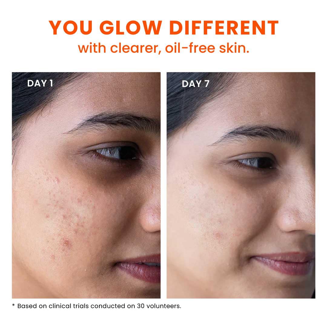 Foxtale Oil and Acne Control Face Wash | 2% Salicylic Acid + Niacinamide + Cica + Hyaluronic Acid | Fights Acne, Fades Marks, Controls Oil, Soothes Skin | Non-Drying Cleanser for Oily Skin FOXTALE