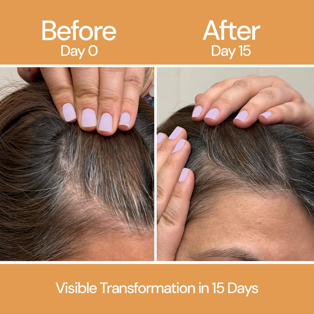 CITTA Hair Growth Serum – Redensyl 3%, Anagain 2%, Capilia Longa 1% with Biotin, Rosemary & Methi – Reduces Hair Fall & Thinning, Promotes Regrowth, Heals Scalp – Dermatologist Tested – 50ml CITTA