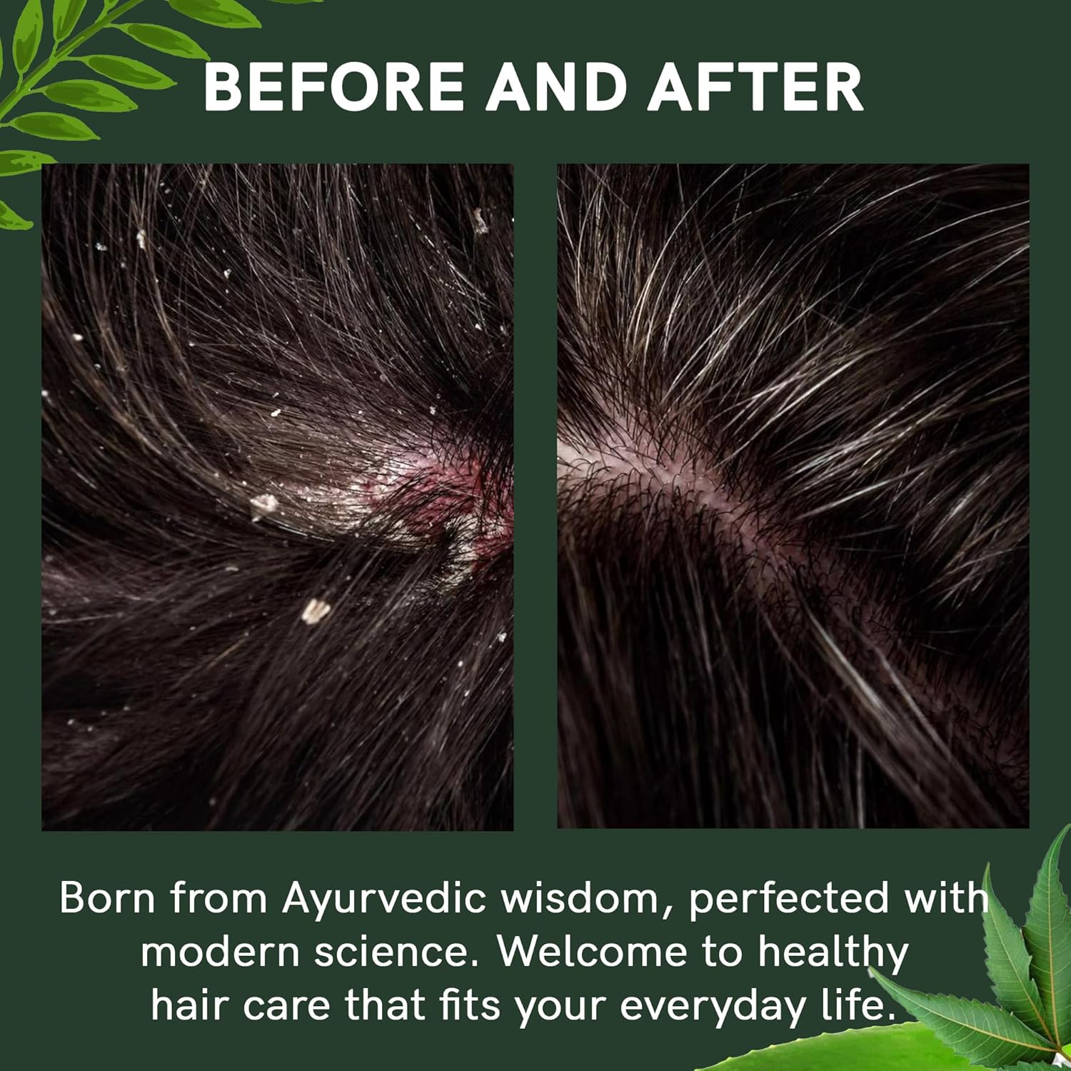Regrowz Anti Dandruff Shampoo - 225ml, Ayurvedic Hair Cleanser With Neem, Tulsi, Aloe Vera & Natural DHT Blockers - Helps With Flakes, Soothe Itchy Scalp, Oil & Dryness - Sulfate Free, Paraben Free Beauty Bumble