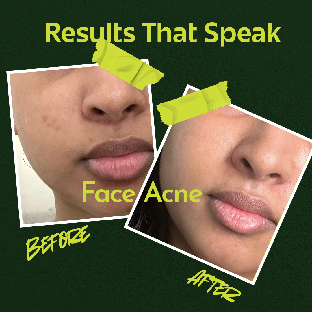 Rivona Genie Hypochlorous Acid Anti-acne toner + serum spray 50ml