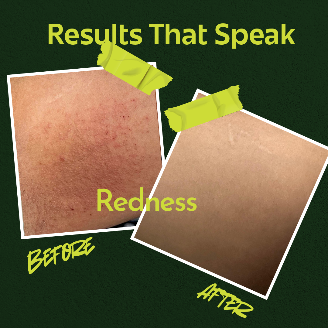 Rivona Genie Hypochlorous Acid Anti-acne toner + serum spray 50ml