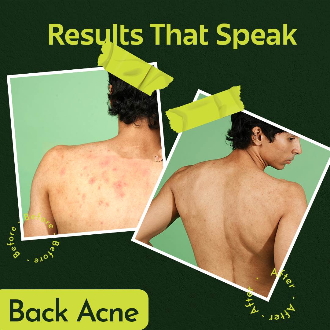 Rivona Genie Hypochlorous Acid Anti-acne toner + serum spray 50ml