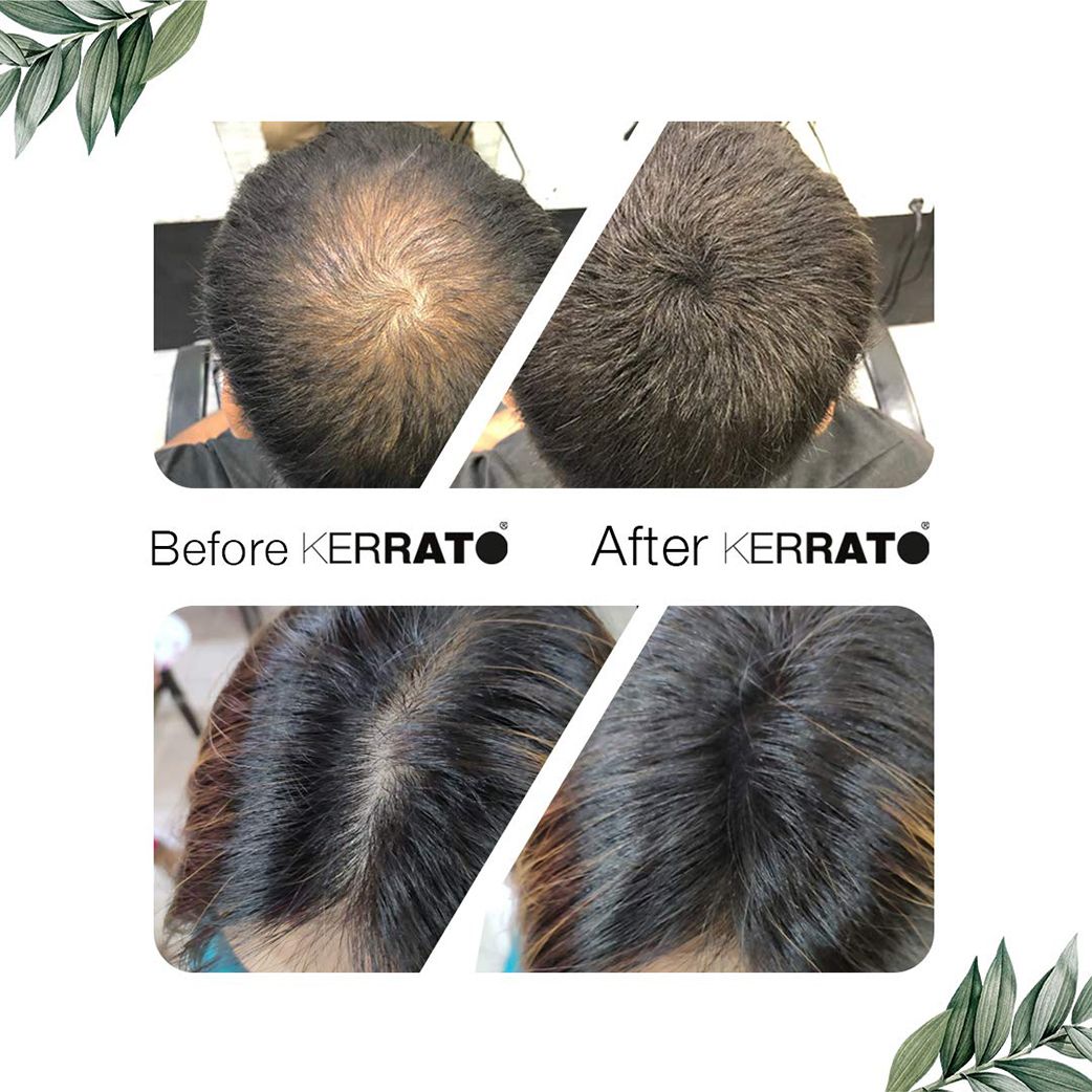 Kerrato Hair Thickening Fibers 28 gms - Dark Brown Kerrato